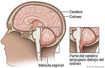 Vista interna de la cabeza, con detalle de parte del cerebro empujada debajo del cráneo