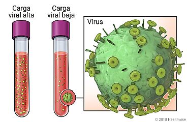 Tubos de muestra de sangre con carga viral alta y carga viral baja, con primer plano del virus de la hepatitis C