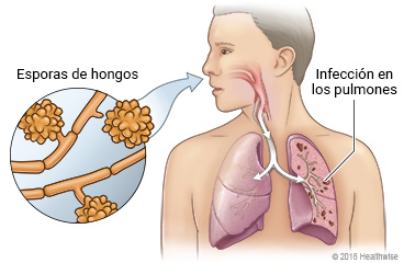 Primer plano de esporas de hongos, inhaladas por la nariz hacia los pulmones y causando infección en los pulmones.