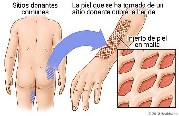 Ubicación de algunas zonas comunes del cuerpo para piel donante, con detalle del injerto de piel en malla que cubre la herida