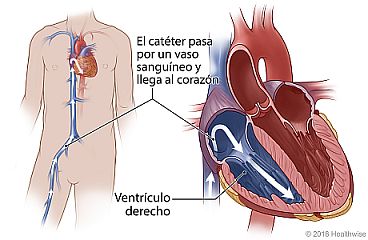 El catéter se desplaza por el vaso sanguíneo desde la ingle al ventrículo cardíaco derecho, con detalle del ventrículo derecho.