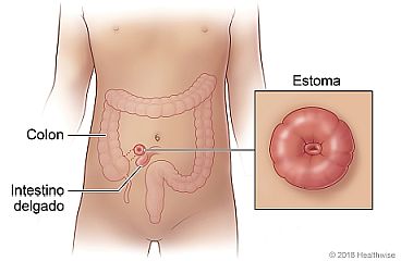 Ubicación del colon, el intestino delgado y el estoma, con detalle del estoma