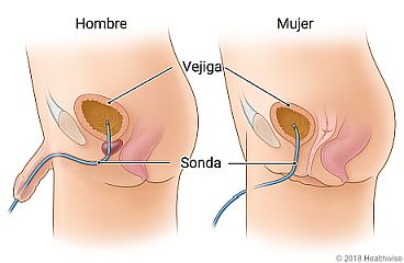 Sonda que va desde el interior de la vejiga hasta el exterior del cuerpo de un hombre y una mujer