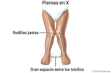 Piernas en X, donde se muestran las rodillas juntas y un gran espacio entre los tobillos