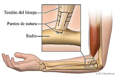 Vista del interior del brazo, con detalle del tendón del bíceps y los puntos de sutura utilizados para unirlo al hueso del antebrazo (radio)