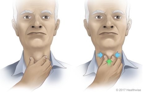 How to do the Mendelsohn maneuver