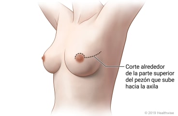 Mastectomía con preservación del pezón con corte periareolar