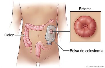 Ubicación del colon en el cuerpo, con bolsa de colostomía colocada sobre un estoma y vista en primer plano de un estoma.