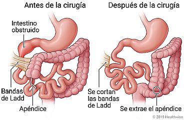 Intestino obstruido, bandas de Ladd y apéndice antes de operar, y comparación con el intestino después de cortarse las bandas de Ladd y extraerse el apéndice.