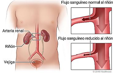 Anatomía de las arterias renales, los riñones y la vejiga, con detalle de la arteria que muestra el flujo sanguíneo normal frente al flujo sanguíneo reducido.