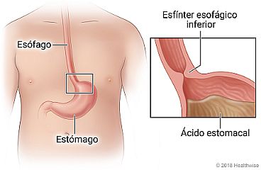 Ubicación del esfínter esofágico inferior entre el esófago y el estómago, con detalle del esfínter y el ácido estomacal