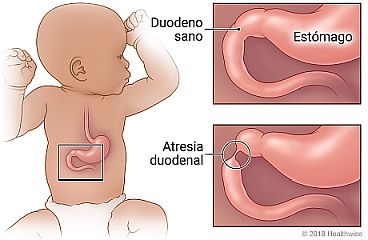 Ubicación del duodeno, con detalle de un duodeno sano y atresia duodenal