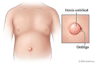 Una hernia umbilical junto al ombligo