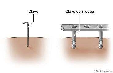 Ejemplos de clavos, con o sin rosca, que salen de la piel