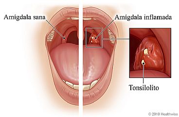 Una amígdala sana comparada con una amígdala inflamada, con detalle de tonsilolito