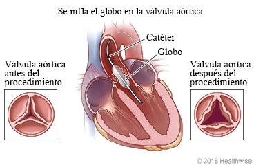 Valvuloplastia con globo, donde se muestra la ubicación del globo en el corazón y la diferencia entre la válvula aórtica antes de la valvuloplastia y después del procedimiento