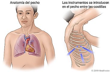 Anatomía del pecho, con vista lateral de donde se introducen los instrumentos quirúrgicos en el pecho entre las costillas.