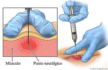 Inyección de medicamento en un punto neurálgico del músculo