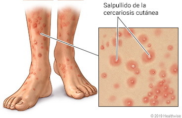 Manchas rojas elevadas del salpullido de la cercariosis cutánea en la parte inferior de las piernas, los tobillos y los pies