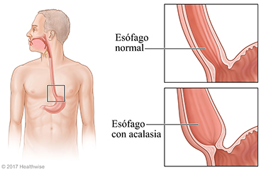 Esófago, con detalle de un esófago normal y uno con una sección inferior ancha con acalasia