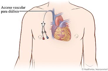 Pecho con catéter para hemodiálisis y acceso vascular