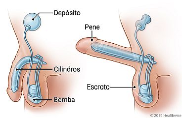 Vista interior del implante de pene inflable, tanto en posición relajada como erecta, que muestra el pene, el escroto, el depósito, los cilindros y la bomba