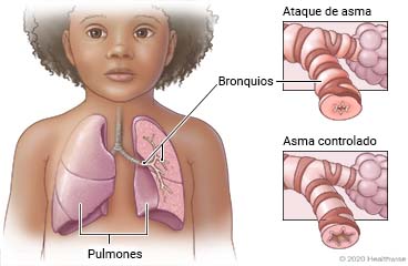 Pulmones en el tórax de un niño mostrando los bronquios, con detalle mostrando el tubo estrechado en un ataque de asma y el tubo parcialmente abierto en un asma controlado