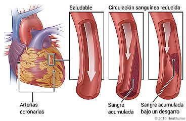 Ubicación de las arterias coronarias en el corazón, con vistas detalladas de circulación sanguínea saludable y circulación sanguínea reducida debido a la acumulación de sangre en la arteria y la acumulación de sangre bajo un desgarro en la pared de la arteria