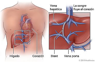 Ubicación del hígado debajo del corazón, con un primer plano del stent en el hígado que une la vena porta y la vena hepática