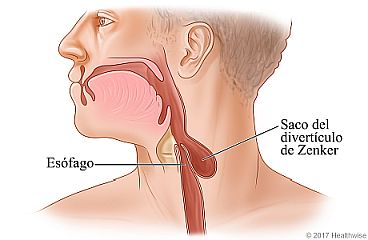 Esófago que muestra un punto débil que causa el saco del divertículo de Zenker