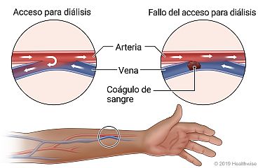 Ubicación de un acceso para hemodiálisis en un brazo, con primeros planos de un tipo común de acceso y un ejemplo de un fallo del acceso