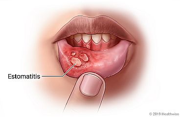 Vista del interior del labio inferior que muestra llagas de estomatitis