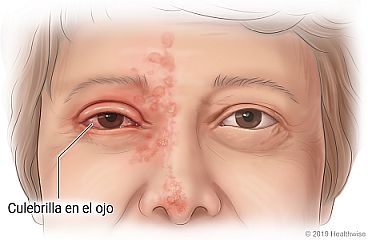 Culebrilla en el ojo, con salpullido en la nariz y la frente