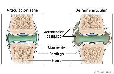 Líquido que se encuentra en una articulación sana, en comparación con una articulación con acumulación de líquido