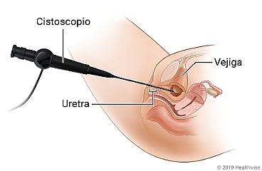 Colocación del cistoscopio en la vejiga a través de la uretra