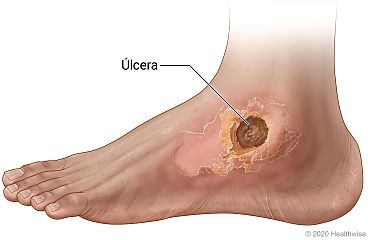 Pie con úlcera cutánea arterial sobre el astrágalo (hueso del tobillo)