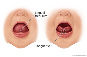 Boca abierta del niño, mostrando un frenillo lingual normal con la lengua levantada hacia arriba y un frenillo lingual corto que sujeta la lengua hacia abajo.