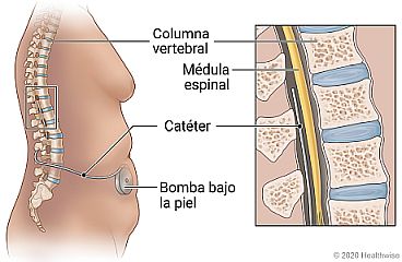 Ubicación del catéter y la bomba debajo de la piel del abdomen, con detalles de la columna vertebral, la médula espinal y la colocación del catéter