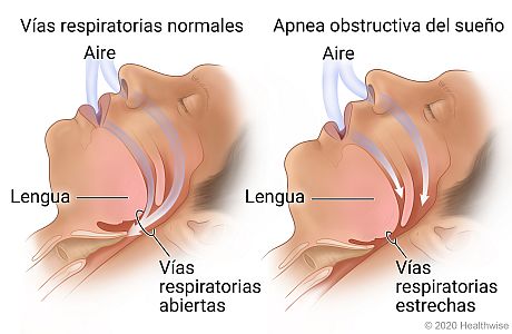 Vías respiratorias normales, donde se muestra el flujo de aire a través de las vías respiratorias abiertas, en comparación con la apnea obstructiva del sueño, que muestra el flujo de aire obstruido por la lengua en las vías respiratorias estrechas.