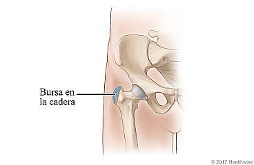 Ubicación de la bursa en el lado externo de la cadera