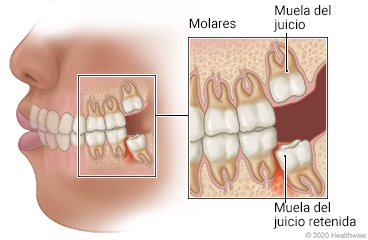 Muelas del juicio al fondo del lado izquierdo de la boca, con primer plano de los seis molares que incluyen una muela del juicio debajo de la encía y una muela del juicio retenida que causa inflamación en el tejido.