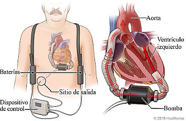 Ubicación del dispositivo de asistencia ventricular (VAD), las baterías y el controlador, con detalle del VAD bombeando sangre desde el ventrículo izquierdo del corazón a la aorta