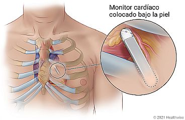 Monitor cardíaco colocado bajo la piel en el pecho cerca del esternón, con detalle de monitor colocado