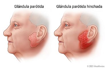 Ubicación de la glándula parótida cerca de la oreja, donde se muestra una glándula parótida sana y una glándula parótida enrojecida e hinchada.