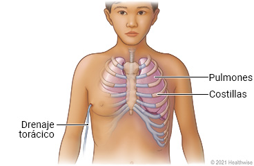 Costillas y pulmones en el pecho, donde se muestra la ubicación del tubo de drenaje torácico al costado del pecho.