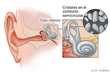 Anatomía del oído, que muestra detalles del oído interno y los conductos semicirculares, con un primer plano de los cálculos en el conducto.