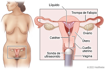 Aparato reproductor femenino (vagina, cuello uterino, útero, ovarios y trompas de Falopio), donde se muestra una sonda de ultrasonido en la vagina y líquido que pasa por el catéter al útero.