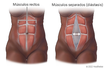 Músculos rectos en la parte delantera del abdomen, donde se muestran los músculos rectos unidos y los músculos rectos separados.