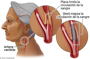 Arteria carótida en un lado del cuello, con detalle del interior de la arteria donde se muestra la placa que limita la circulación de la sangre y detalle de stent colocado que mejora la circulación de la sangre.