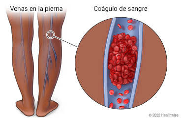 Parte posterior de las piernas donde se muestran las venas profundas, con detalle de un trombo formado dentro de una vena.